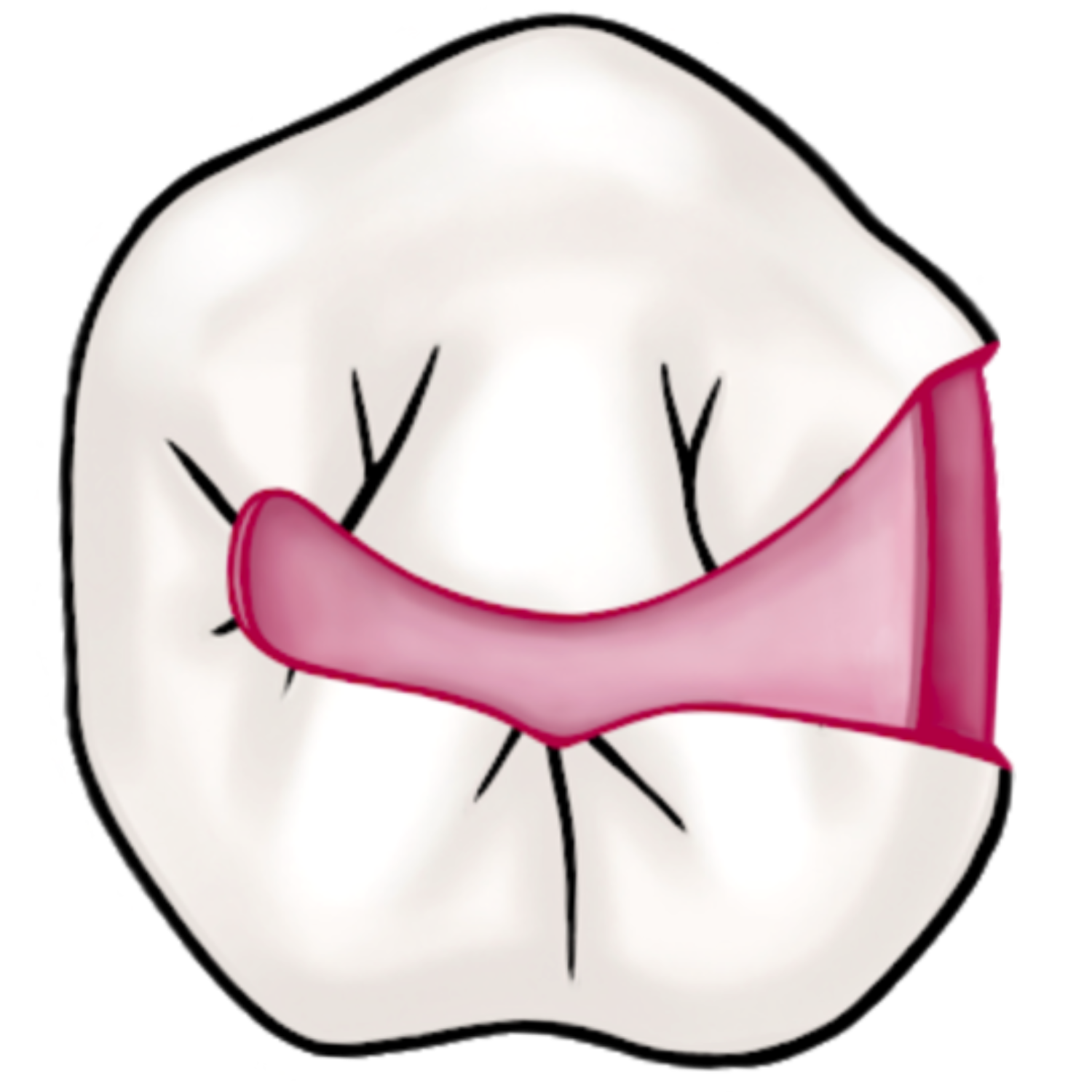 Class II Amalgam Preparation My Dental Key
