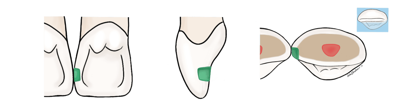 Class III Composite Preparation - My Dental Key