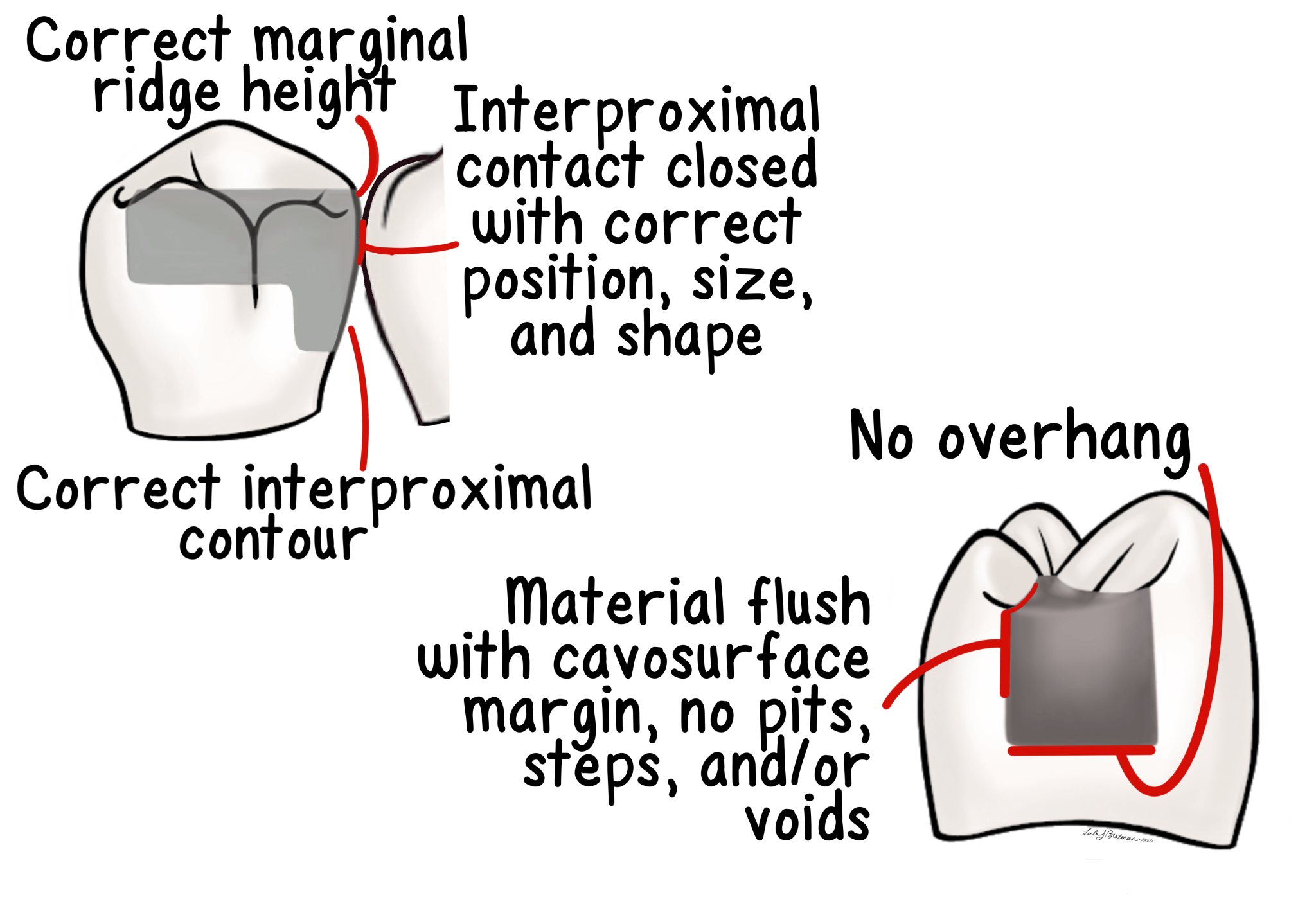 Class II Amalgam Restoration - My Dental Key